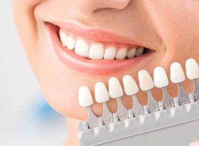 3 TEETH FILLINGS & BONDING