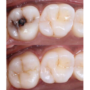 WHAT ARE COMPOSITE FILLINGS 1