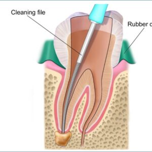 WHAT IS INVOLVED IN A ROOT CANAL 1
