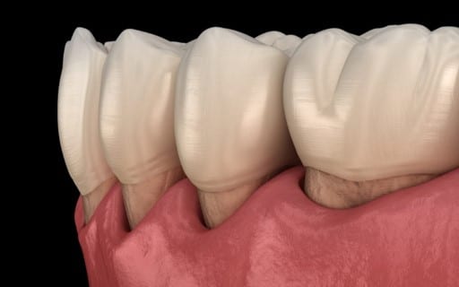 WHAT HAPPENS IF GUM DISEASE IS NOT TREATED 1