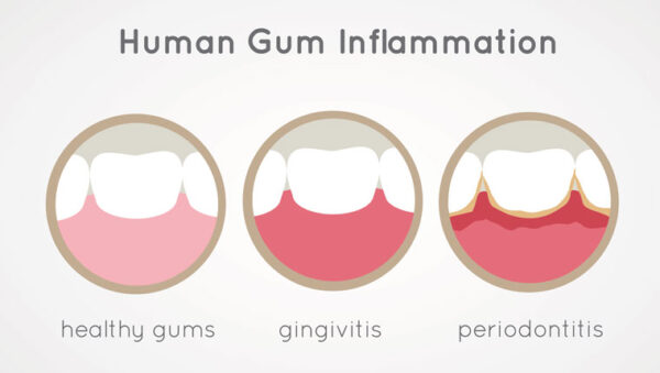 WHAT IS GINGIVITIS AND PERIODONTAL DISEASE