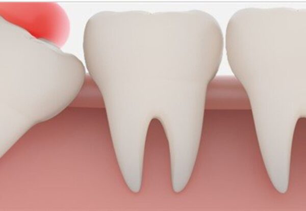 Wisdom teeth what you need to know